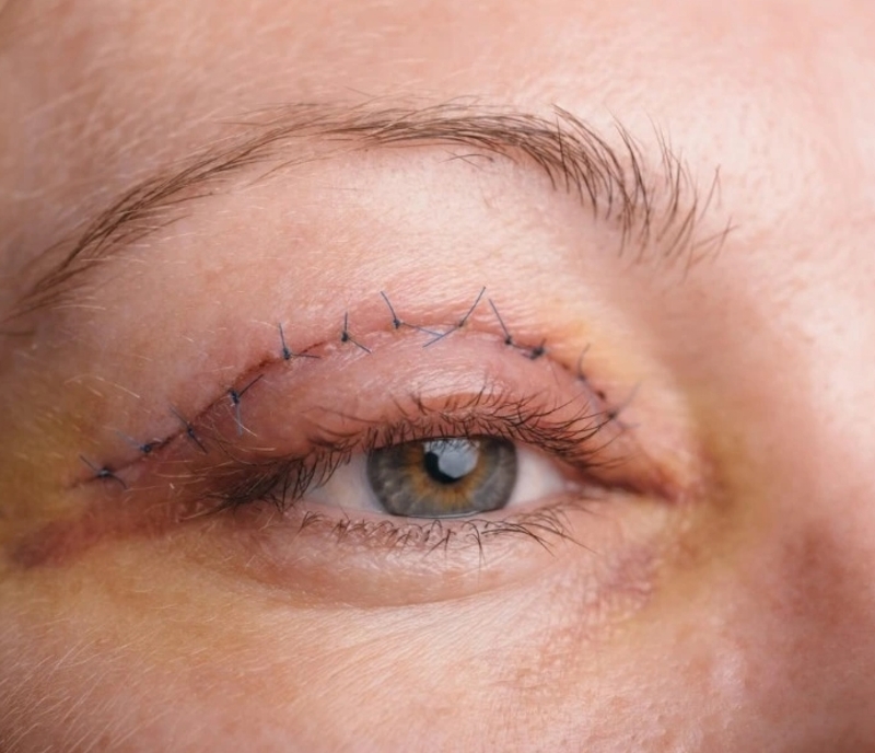 Trong những ngày đầu, mí thường sưng và bầm nhẹ nên cần nghỉ ngơi, chườm lạnh đúng cách. 