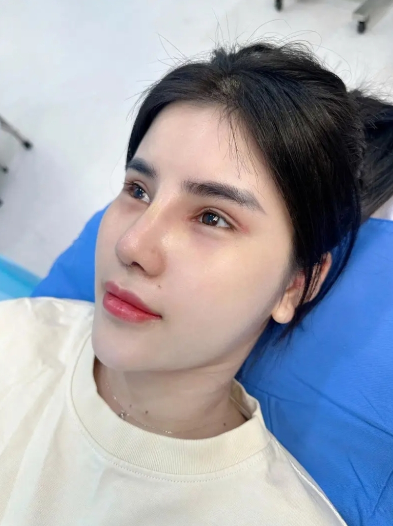 Khoảng 2 tuần sau cắt mí, khuôn mặt thường bớt sưng và dễ tự tin hơn khi ra ngoài. 