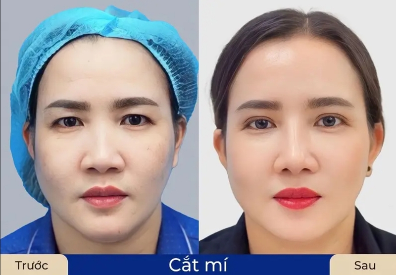 Giai đoạn 1–3 tháng là thời điểm mí dần mềm, hài hòa và tự nhiên hơn với gương mặt. 