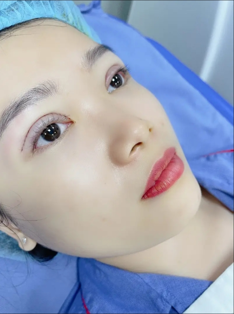 Sưng nhẹ, bầm tím và cảm giác căng mí là những biểu hiện thường gặp trong giai đoạn đầu. 