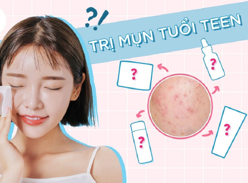 Cách trị mụn tuổi dậy thì khoa học giúp da sạch mịn nhanh