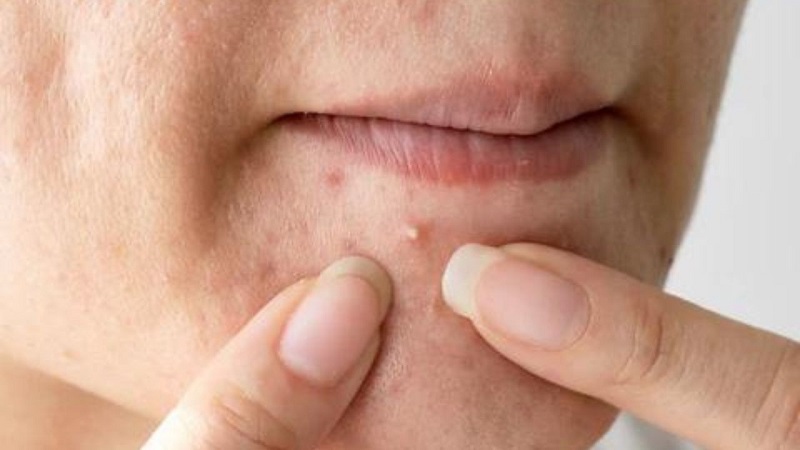 Hoạt chất Salicylic Acid (BHA) giúp tan dầu và thông thoáng lỗ chân lông bị bít tắc.