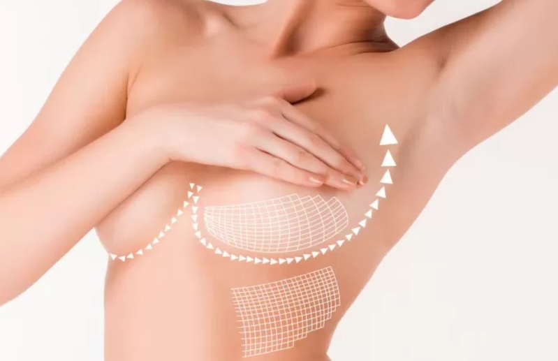 Nâng ngực không phẫu thuật là nhóm giải pháp thẩm mỹ cần được hiểu đúng trước khi lựa chọn. 