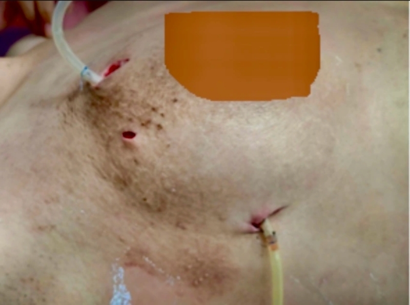 Tiêm filler hoặc silicone lỏng vào ngực không rõ nguồn gốc có thể gây biến chứng nghiêm trọng. 