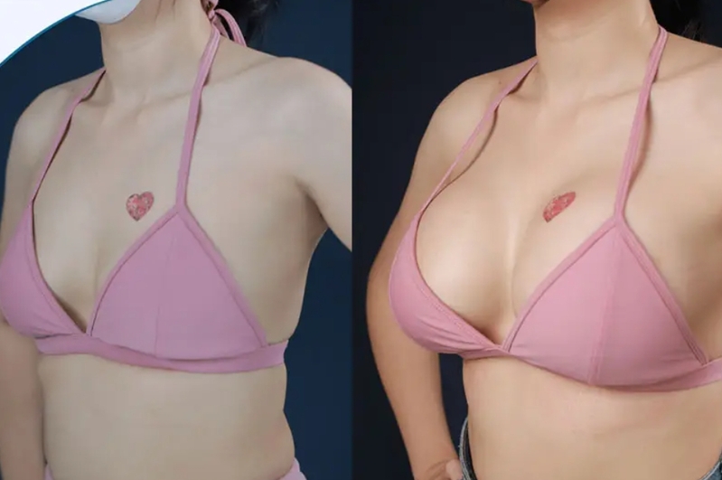 Nâng ngực không phẫu thuật phù hợp hơn với người muốn cải thiện nhẹ và có kỳ vọng thực tế. 